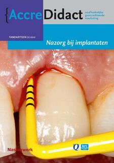 Nazorg bij implantaten - Gordon van der Avoort (ISBN 9789089761620)