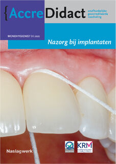 Nazorg bij implantaten - Gordon van der Avoort, Erik Blom (ISBN 9789089763563)