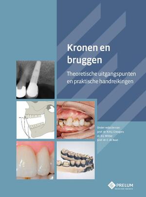 Kronen en bruggen - Kronen en bruggen -