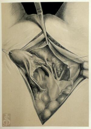 Die erweiterte abdominale Operation bei carcinoma colli uteri - E. Wertheim Die erweiterte abdominale Operation bei carcinoma colli uteri - E. Wertheim